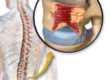 220px-Blausen_0656_MultipleMyeloma