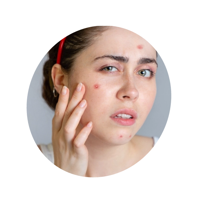 Close-up image of a girl's face affected by acne