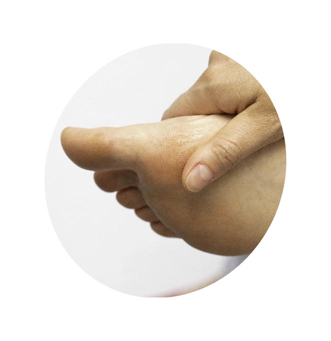 Close-up view of a person's feet with Athlete’s Foot condition.