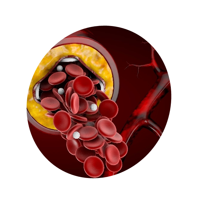 Illustration of an artery with fatty deposits depicting the causes of lipid disorders